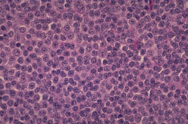 Неходжкинская лимфома Неходжкинская лимфома