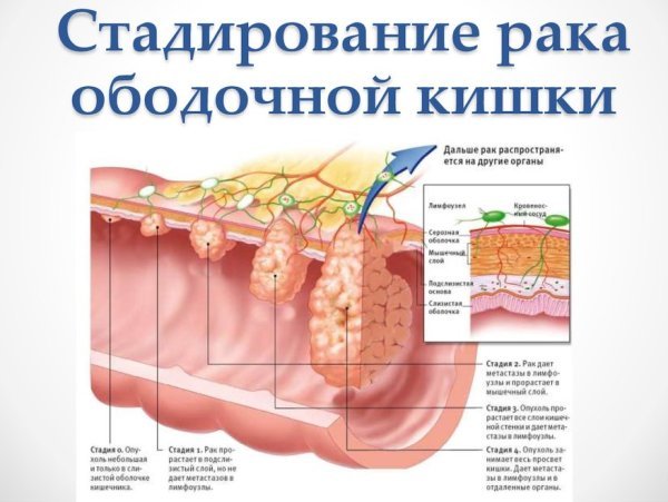 Стадирование рака ободочной кишки Стадирование рака ободочной кишки