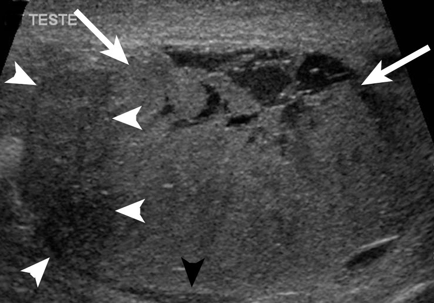 опухоль яичка у мужчин узи опухоль яичка у мужчин узи