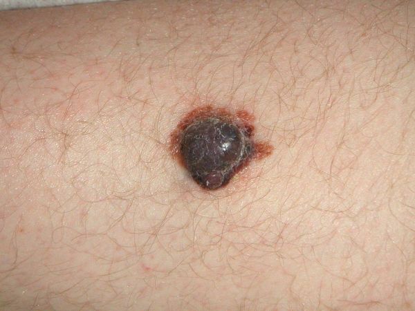 Нодулярная, или узловая меланома Нодулярная, или узловая меланома