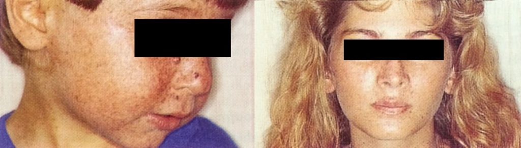 Пигментная ксеродерма Пигментная ксеродерма