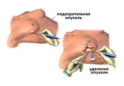 Секторальная резекция Секторальная резекция