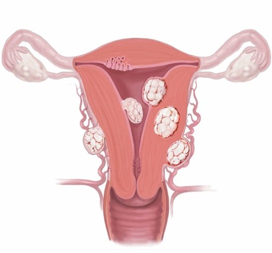 фиброма матки фиброма матки