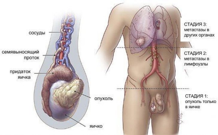 опухоль яичка у мужчин опухоль яичка у мужчин