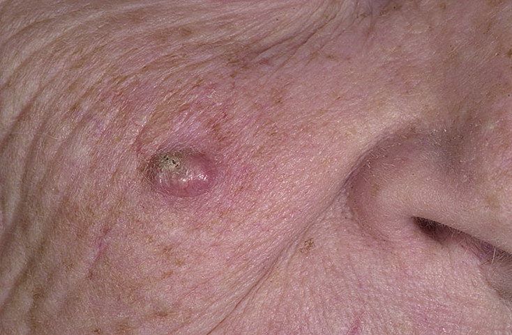 Кератоакантома