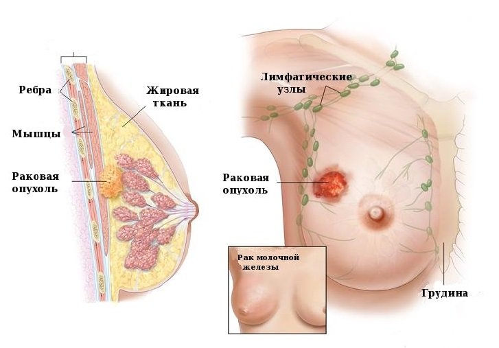 Рак молочной железы Рак молочной железы