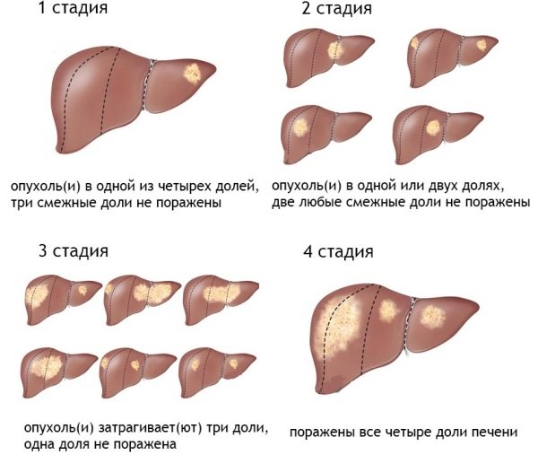 Опухоль на печени 4 стадии Опухоль на печени 4 стадии