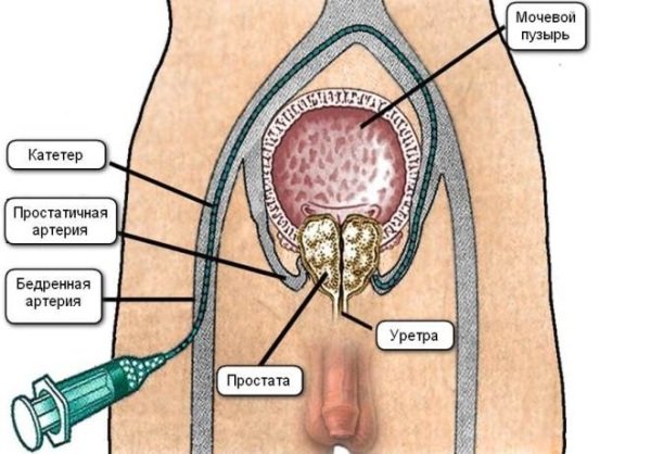Эмболизация артерий простаты Эмболизация артерий простаты