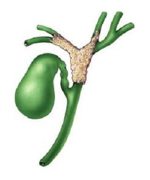 Опухоль Клацкина (Холангиокарцинома) Опухоль Клацкина (Холангиокарцинома)