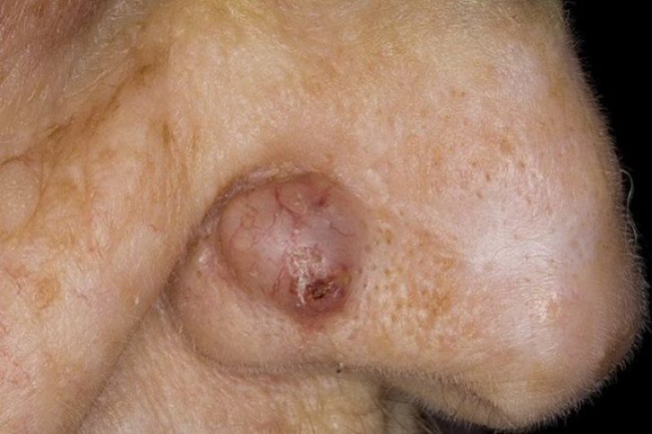 узелковая форма базалиомы узелковая форма базалиомы