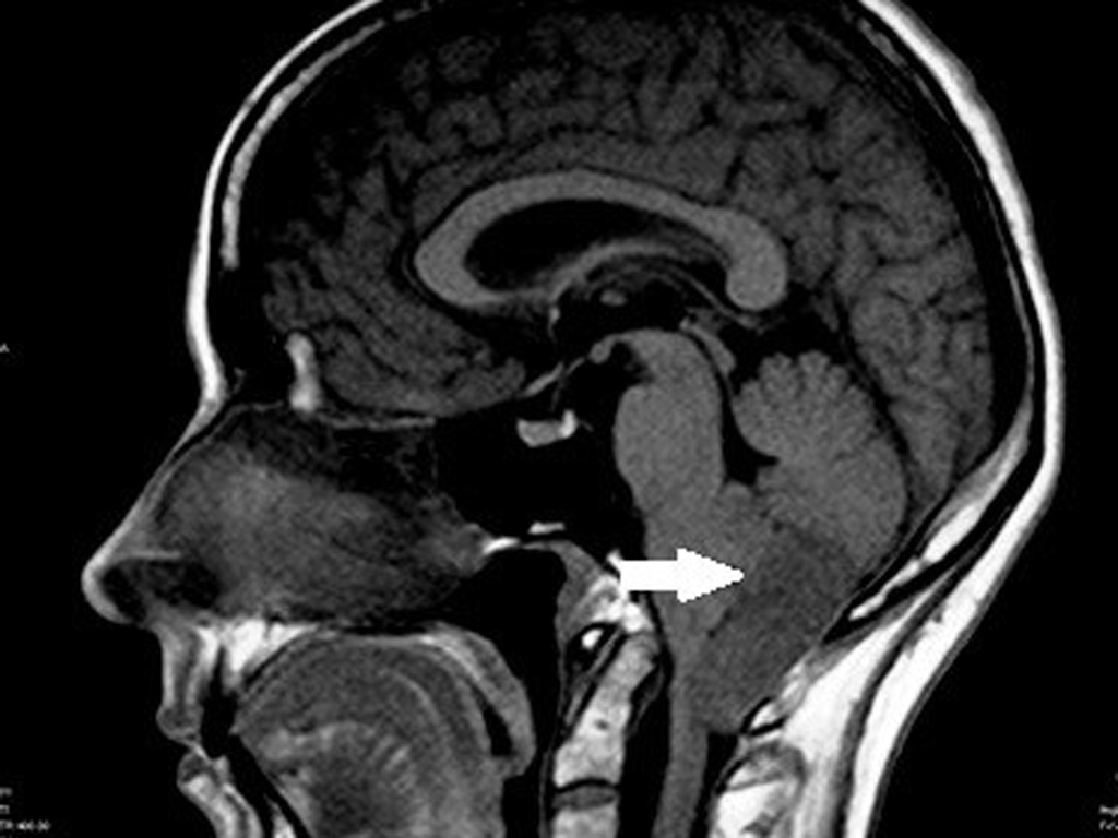 Эпендимома - опухоль головного мозга Эпендимома - опухоль головного мозга