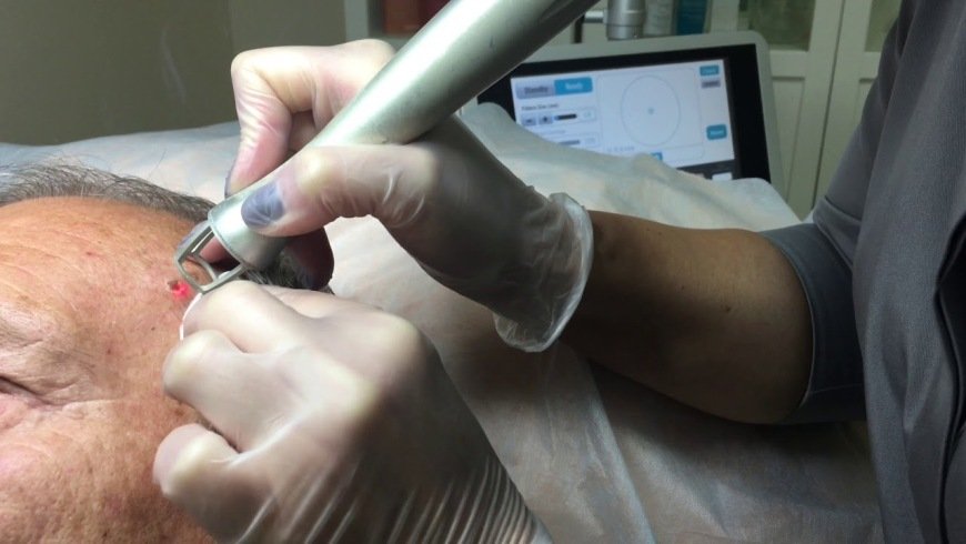 Лазерное удаление кожного рога Лазерное удаление кожного рога