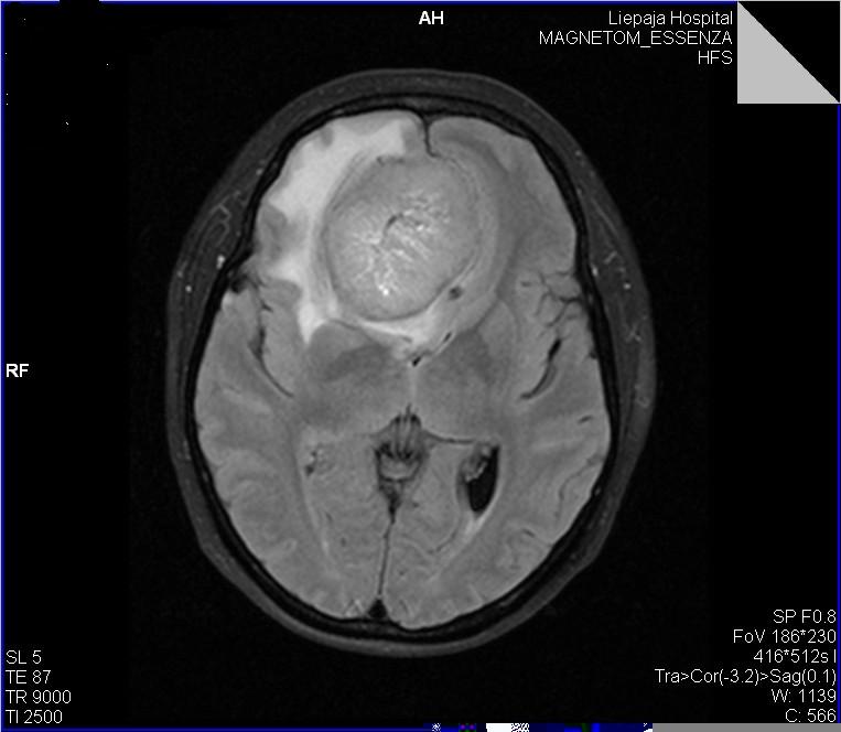 опухоль мозга опухоль мозга