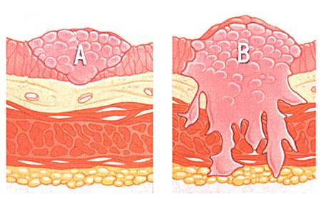 Малигнизация полипа Малигнизация полипа