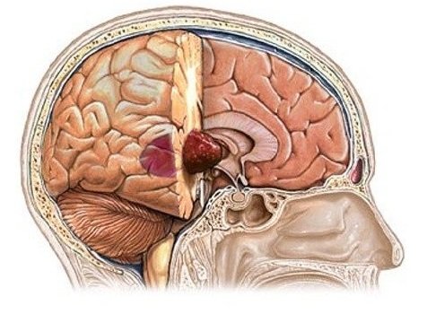 Опухоль головного мозга Опухоль головного мозга