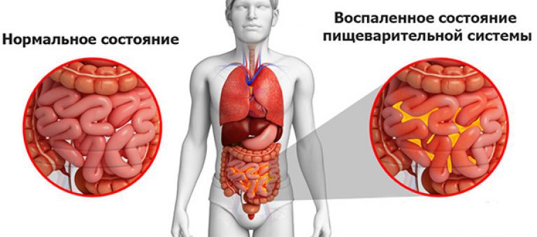 Перитонит Перитонит