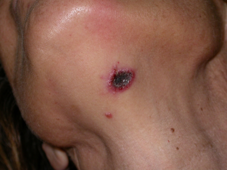 Неходжкинская лимфома Неходжкинская лимфома