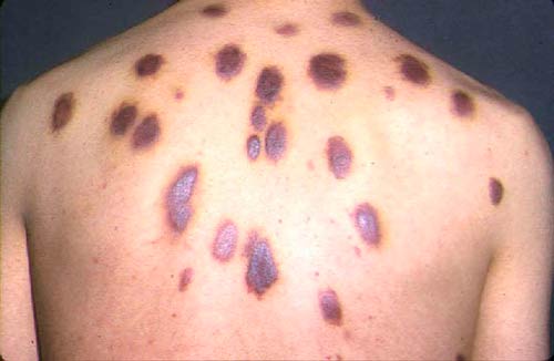 Саркома Капоши Саркома Капоши