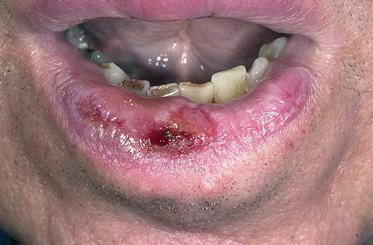 рак губы рак губы