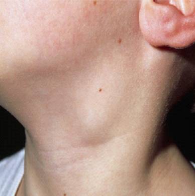 Лимфома Ходжкина Лимфома Ходжкина