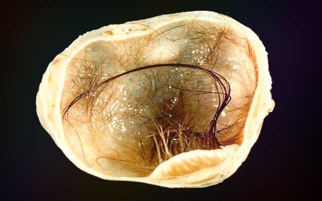 тератома тератома