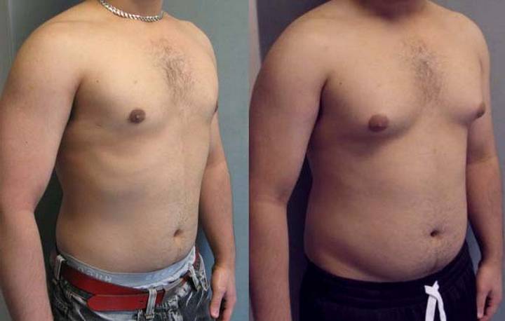 Увеличение грудной железы у мужчин Увеличение грудной железы у мужчин