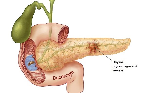 Опухоль поджелудочной железы Опухоль поджелудочной железы