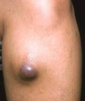 Фибросаркома мягких тканей Фибросаркома