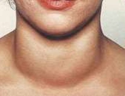 Тиреоидит Хашимото Тиреоидит Хашимото