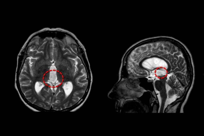 опухоль головы опухоль головы