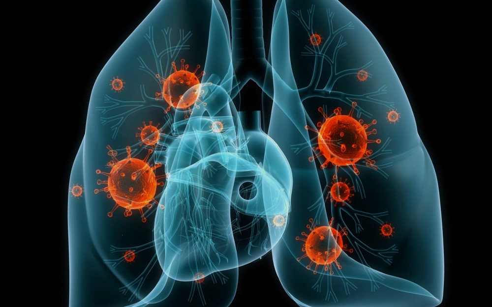 аденокарцинома легкого может привести к смерти в очень короткие сроки