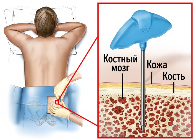 Трансплантация костного мозга Трансплантация костного мозга