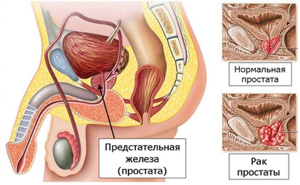 Рак предстательной железы Рак предстательной железы