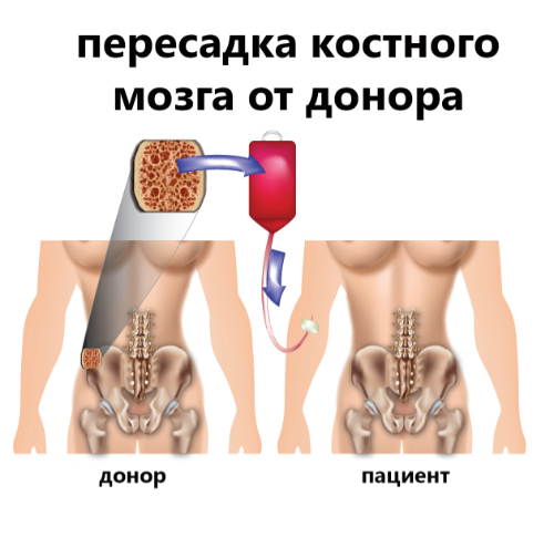 пересадка костного мозга от донора пересадка костного мозга от донора