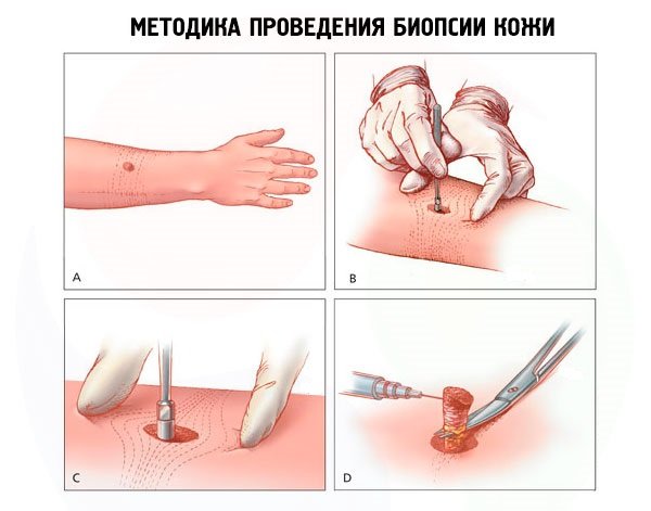 Биопсия кожи Биопсия кожи