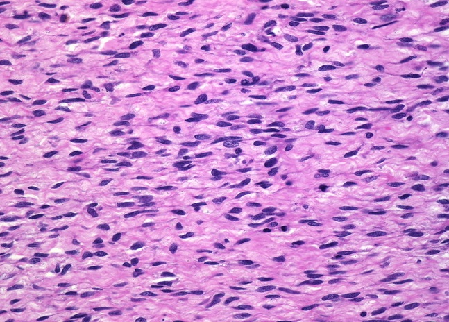 Микропрепарат фибросаркомы