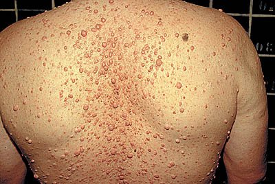 болезнь Фон Реглингхаузена