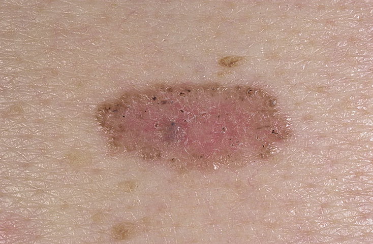 базалиома кожи лица фото