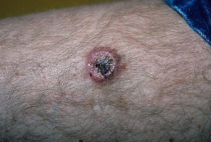 дерматофибросаркома выбухающая дерматофибросаркома