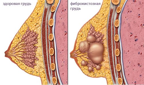 Фиброаденоматоз