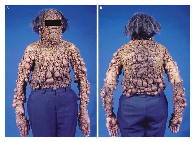 Нейрофиброматоз