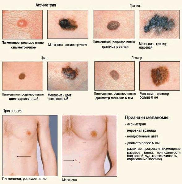 как выглядит меланома кожи фото начальная стадия