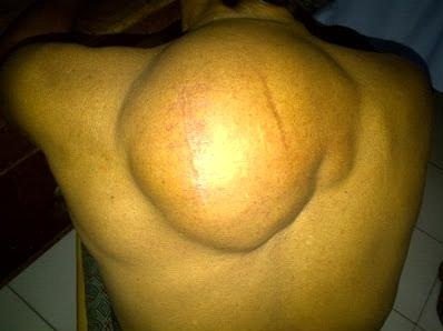 крупная липома на спине крупная липома на спине