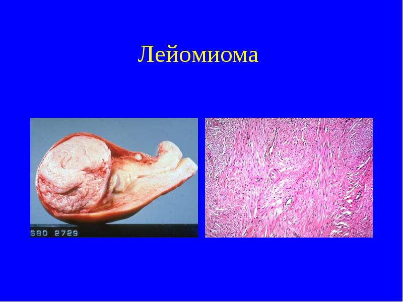 лейомиома