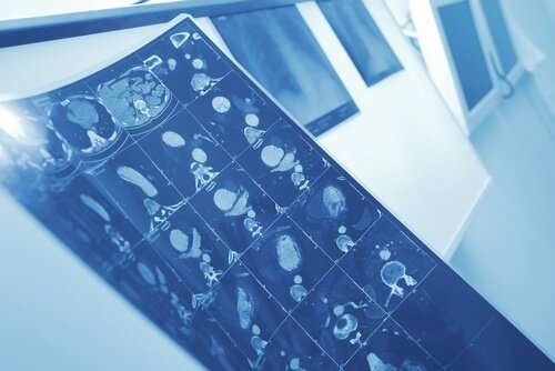 Методы лечения лимфомы в Израиле