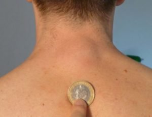 жировик на спине жировик на спине