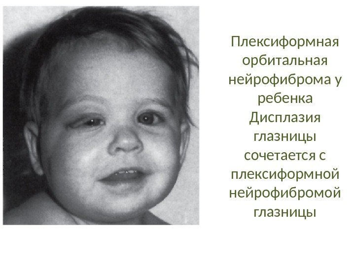 нейрофиброма у детей