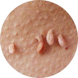 Папилломы папилломы