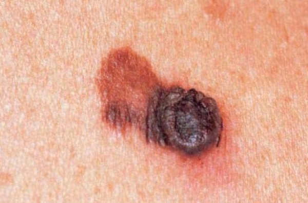 Узловая меланома на фоне пигментного пятна Узловая меланома на фоне пигментного пятна