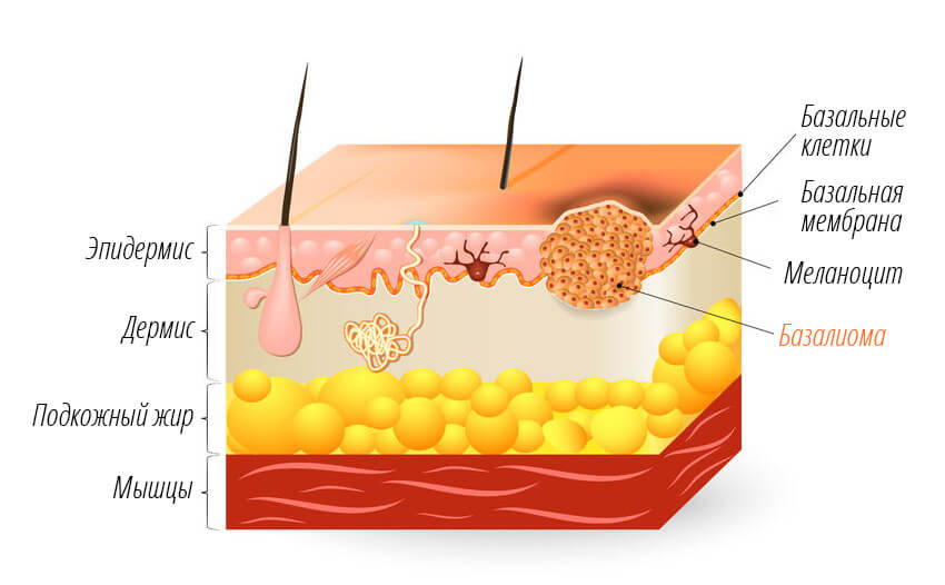 базалиома кожи базалиома кожи